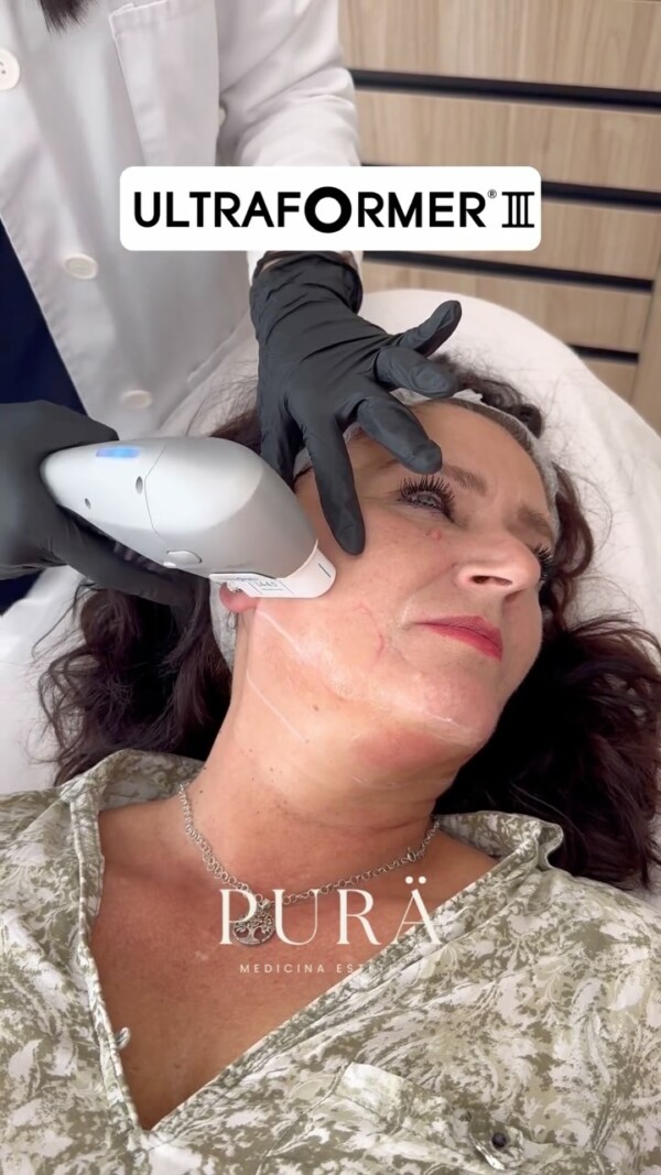 ✨ Descubre el poder del lifting sin cirugía con Ultraformer III ✨En PURÄ, estamos revolucionando el rejuvenecimiento facial y de papada con Haifu Ultraformer 3, el tratamiento de ultrasonido focalizado que redefine y tensa la piel sin necesidad de bisturí. Hoy, nuestra bella paciente experimenta este innovador procedimiento para lograr una piel más firme y un contorno redefinido, con resultados naturales y duraderos.

¿Quieres saber cómo este tratamiento puede transformarte? 

Escríbenos y descubre el camino hacia una versión más joven y radiante de ti misma. ¡Tu piel merece lo mejor! 🌿

hifumalaga ultraformer ultraformer3